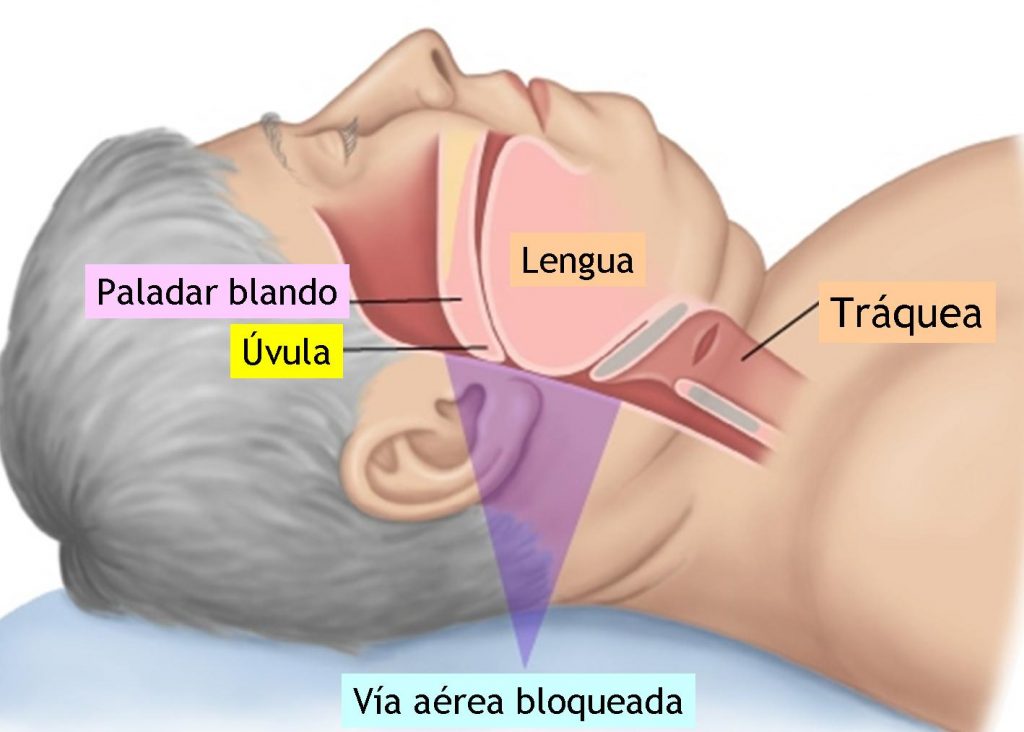 Cómo curar la apnea del sueño en Valladolid - Ortoinvisible