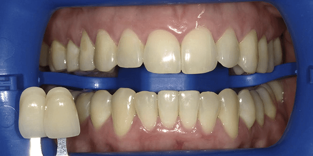 En qué consiste el tratamiento dental