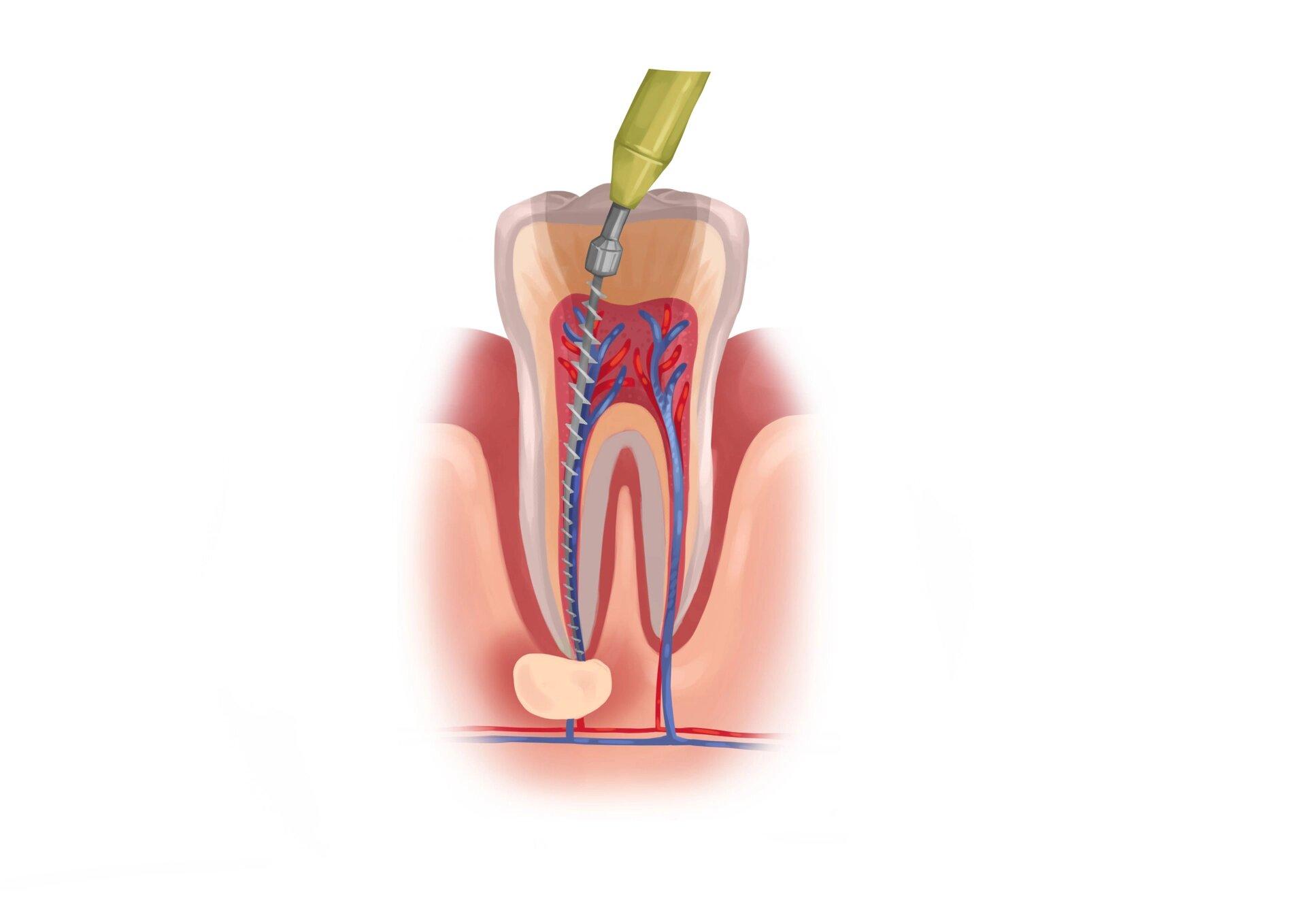 diferencia entre empaste y endodoncia