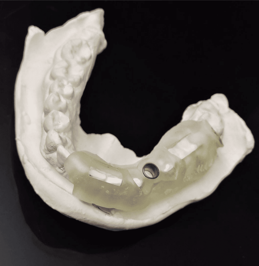 Férula para implantes dentales