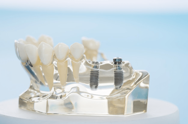 Implantes dentales y prótesis en Valladolid