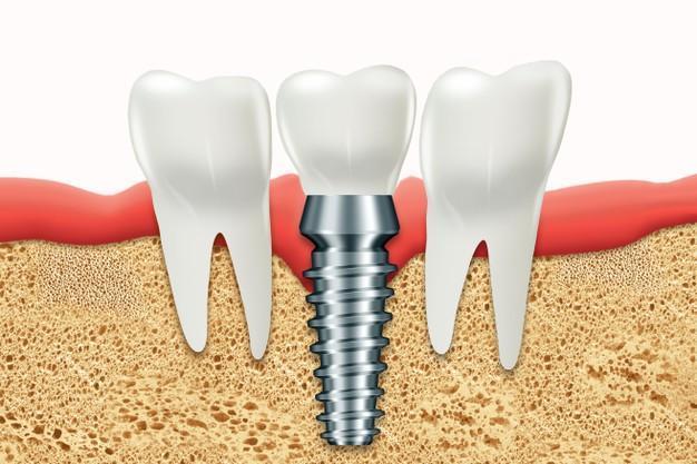Diferencia entre implantes dentales y puentes