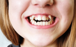 Tratamientos con ortodoncia invisible