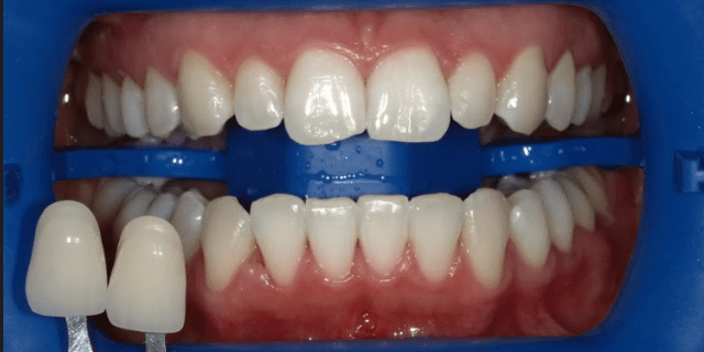 Resultado del blanqueamiento dental