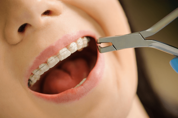 Ortodoncia con brackets de zafiro