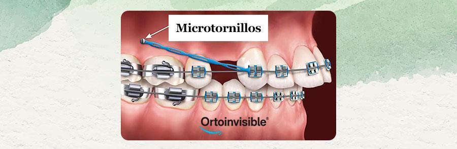 Cuando se usan los microtornillos en ortodoncia