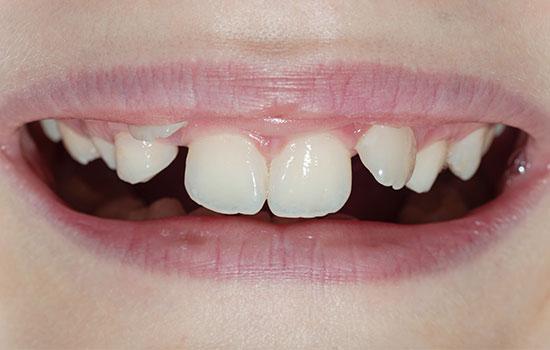 ¿Cuándo es mejor poner ortodoncia interceptiva en niños?