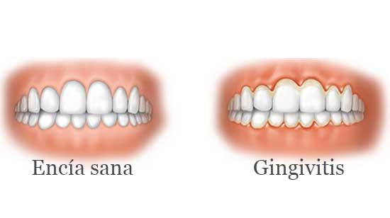 Diferencia entre encía sana y gingivitis