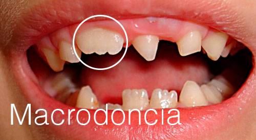 macrodoncia o dientes grandes