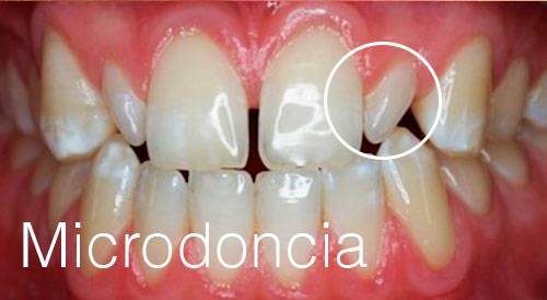microdoncia o dientes pequeños