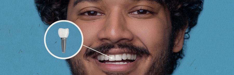articulo sobre rehabilitar la sonrisa con implantes dentales