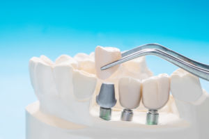implantes dentales en valladolid