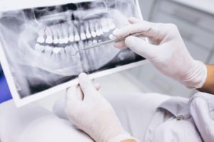 dentista en Valladolid para fractura de diente