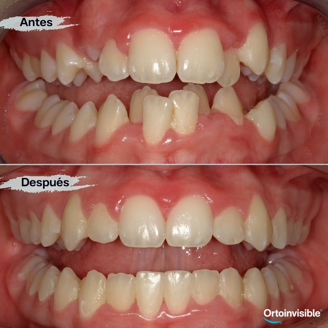 Caso de apiñamiento resuelto con ortodoncia