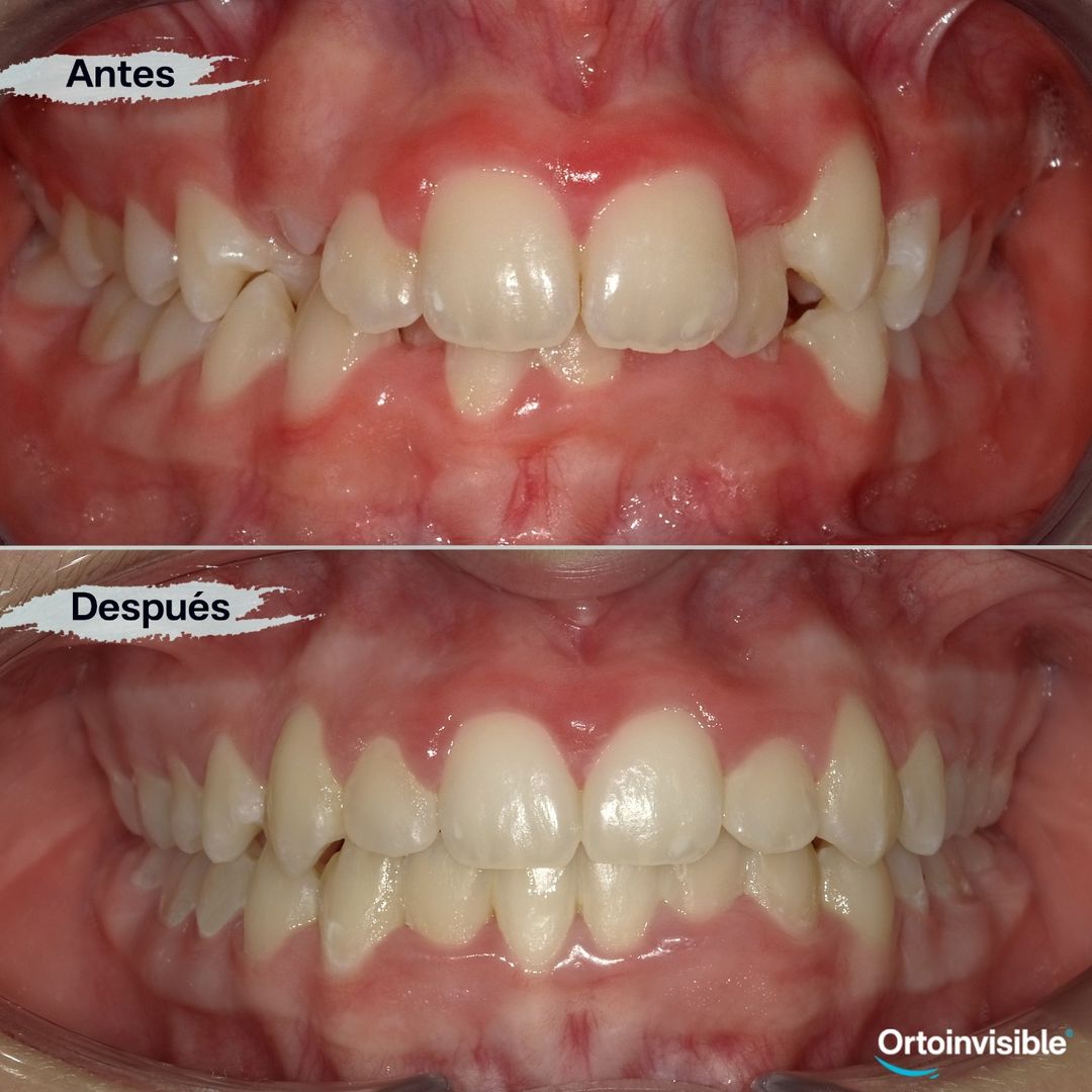 Caso de apiñamiento resuelto con ortodoncia invisible