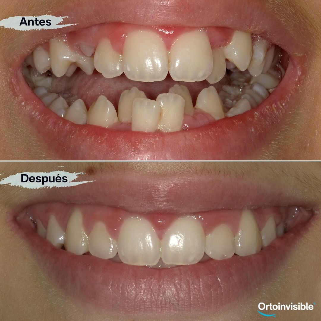Caso de apiñamiento resuelto con ortodoncia invisible