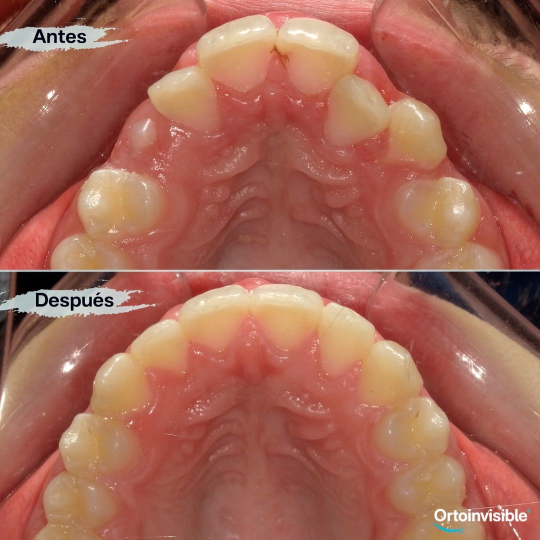 Caso de apiñamiento resuelto con ortodoncia