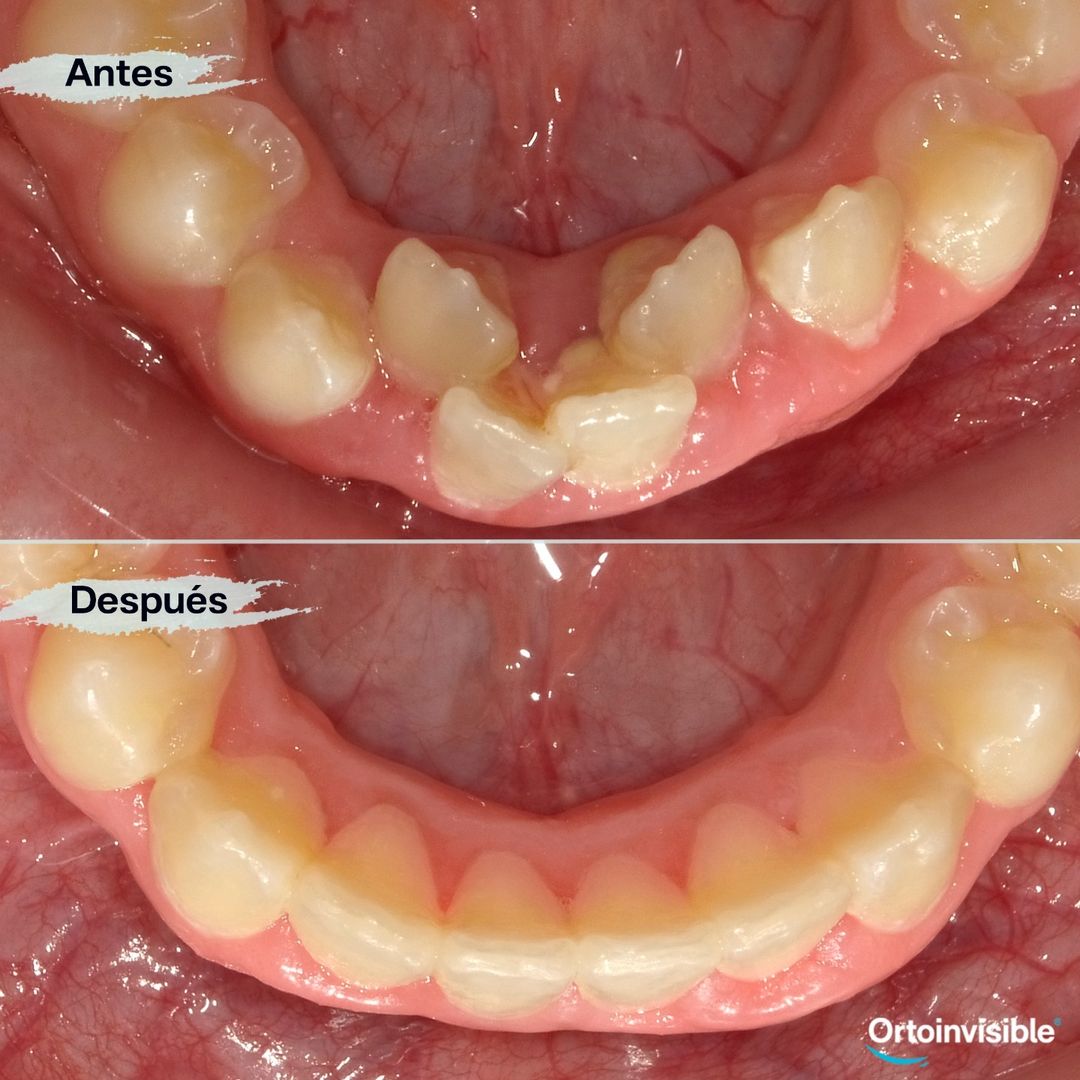 Caso de apiñamiento dental resuelto con ortodoncia invisible