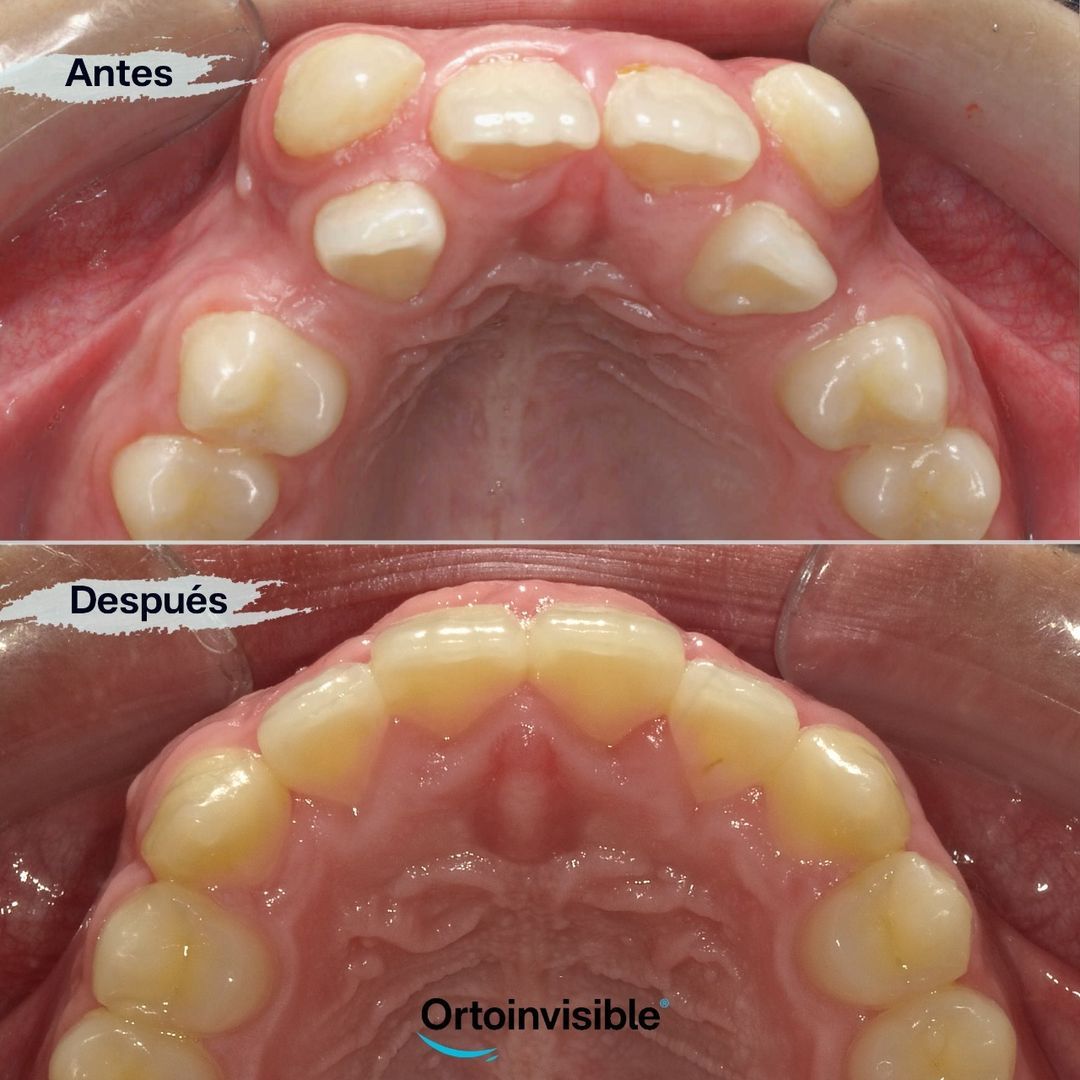 Caso de éxito de tratamiento de ortodoncia