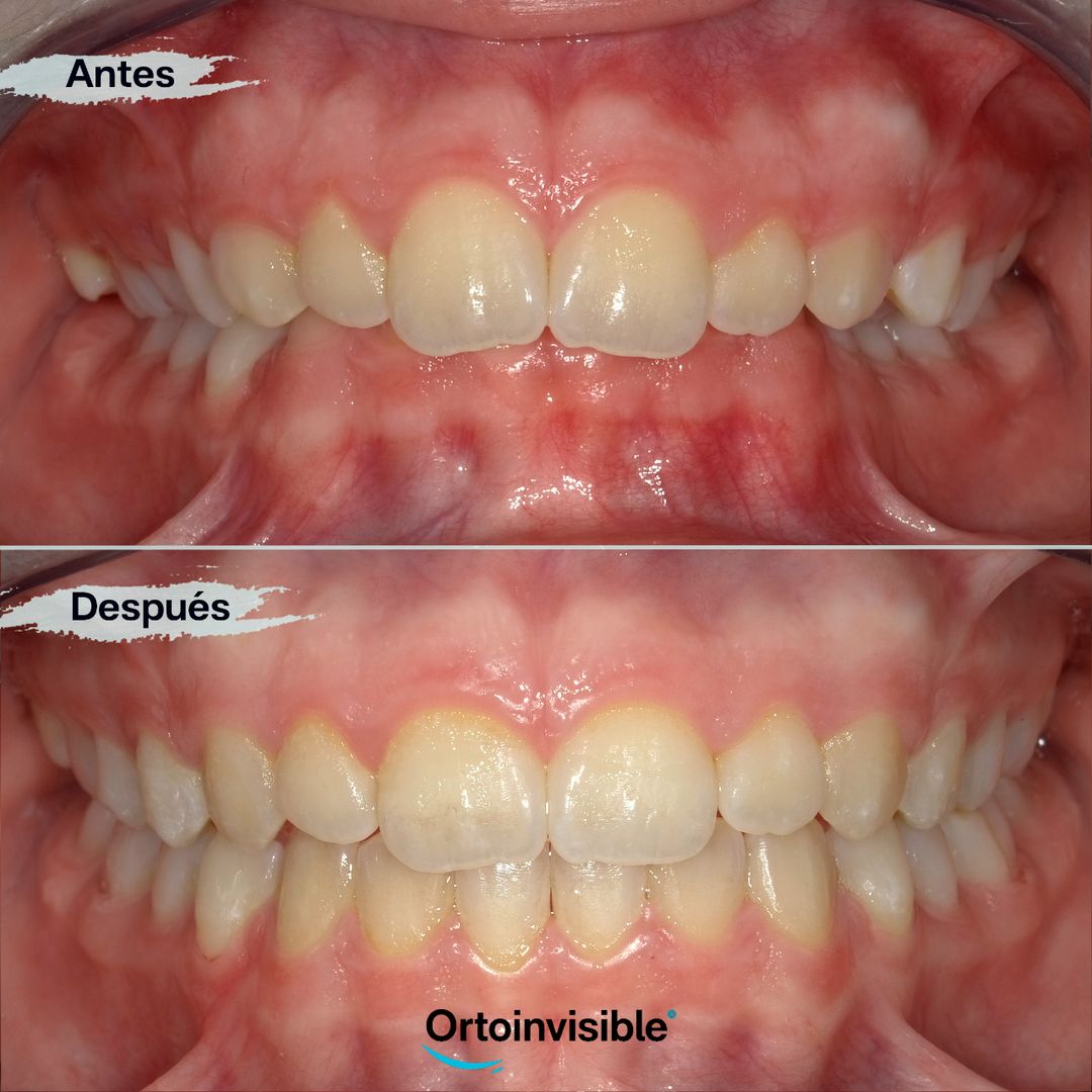 Avance mandibular corregido con ortodoncia invisible