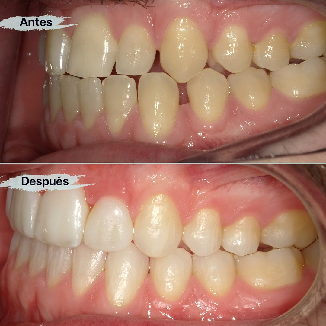 Caso de éxito con carillas de composite, blanqueamiento y ortodoncia